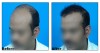 Radiance Hair Transplant